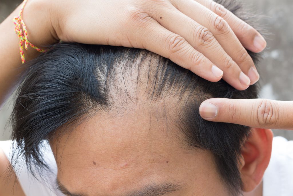 Taxotere Hair Loss Claims  US Recall News