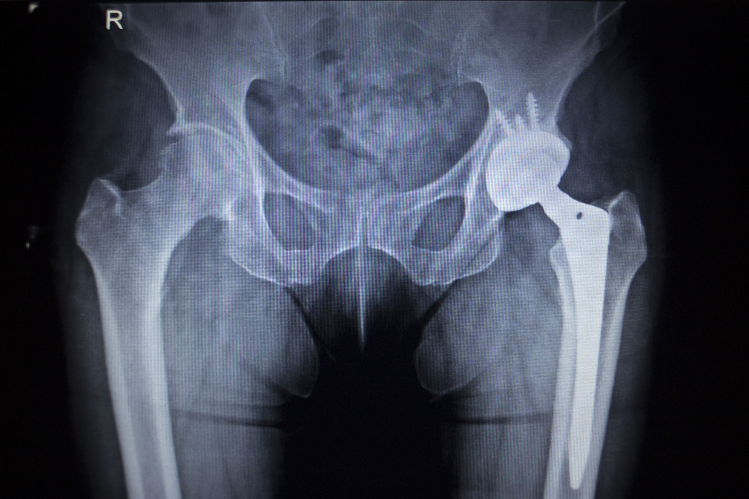 500 Million Award Reduced in Faulty Hip Implant Case US Recall News
