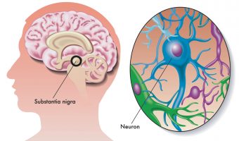 Parkinsons