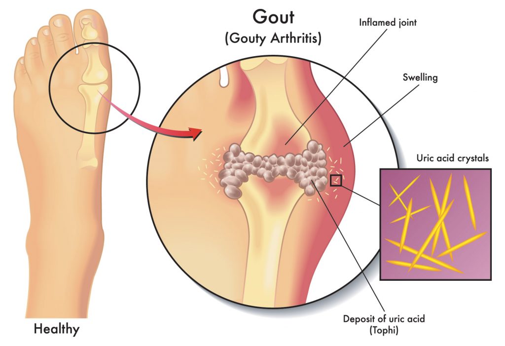 Gout