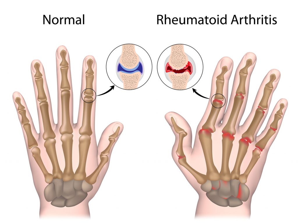 rheumatoid arthritis