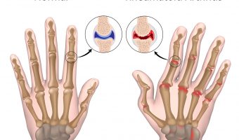 rheumatoid arthritis